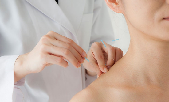 Acupuncture