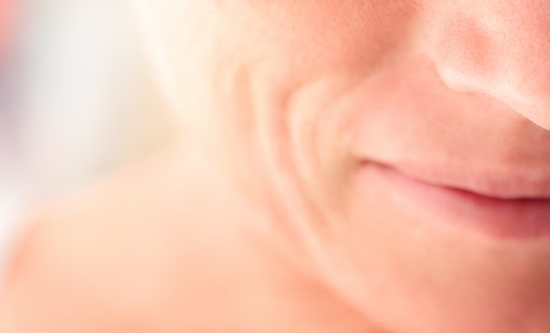 Restylane® Marionette Lines Treatment