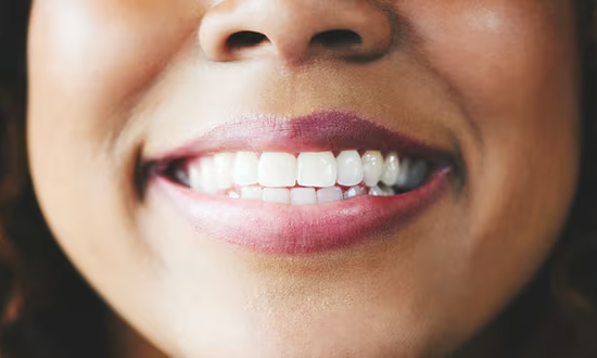 Restylane® Lip Lines Treatment